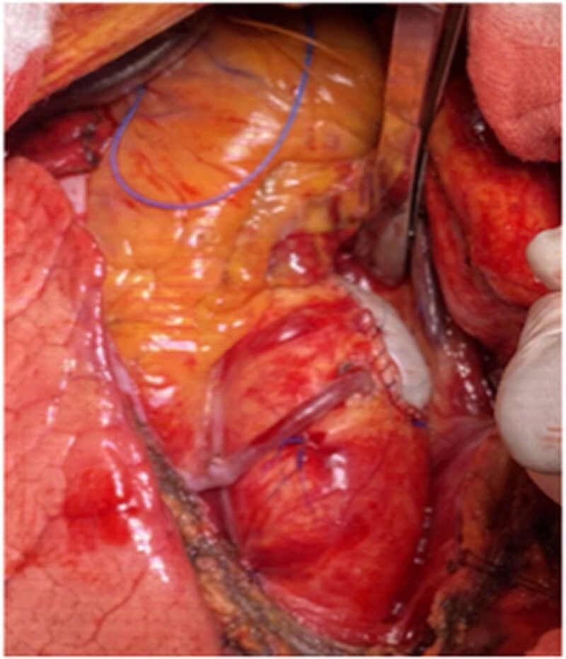 Porcelain aorta does not mean inoperability but needs special strategies.