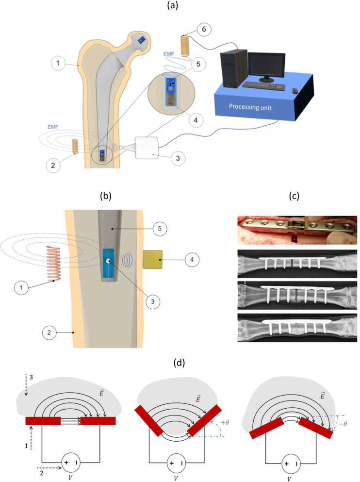 Bioelectronic multifunctional bone implants: recent trends.