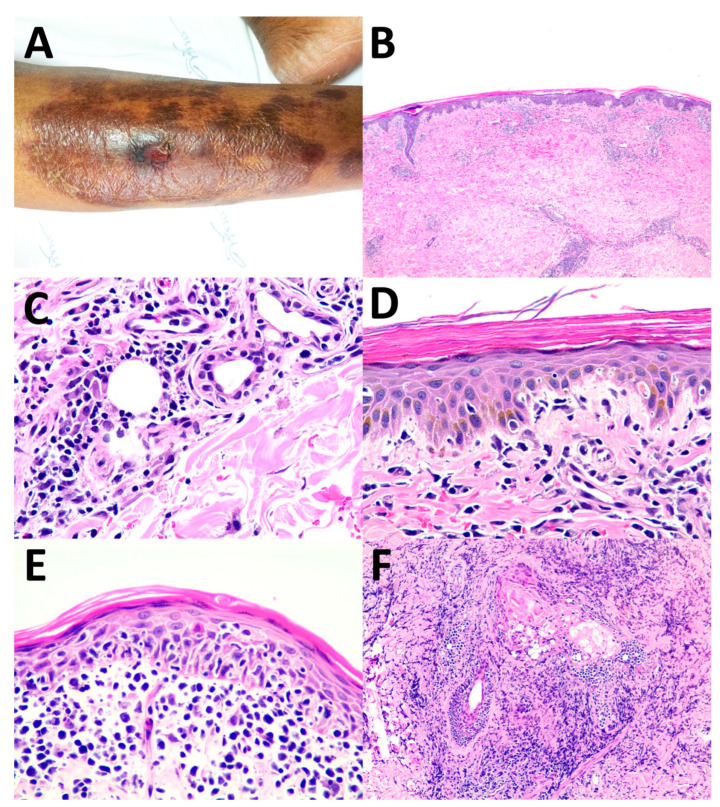 Cutaneous Involvement of Extranodal NK/T Cell Lymphoma, Nasal Type, a Clinical and Histopathological Mimicker of Various Skin Diseases.