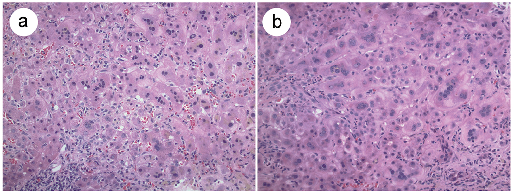 Post-infantile Giant Cell Hepatitis: A Literature Review and Meta-analysis.