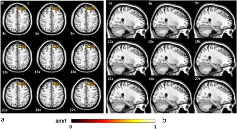 Optical neuroimaging: advancing transcranial magnetic stimulation treatments of psychiatric disorders.