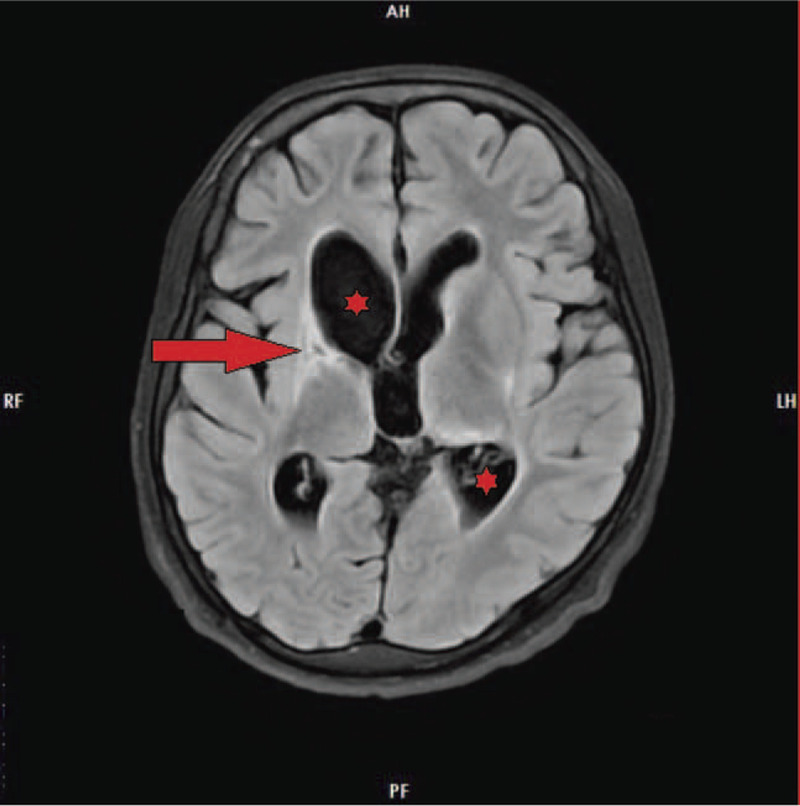 A case report on disseminated tuberculosis in the setting of coronavirus disease 2019: cause or consequence?