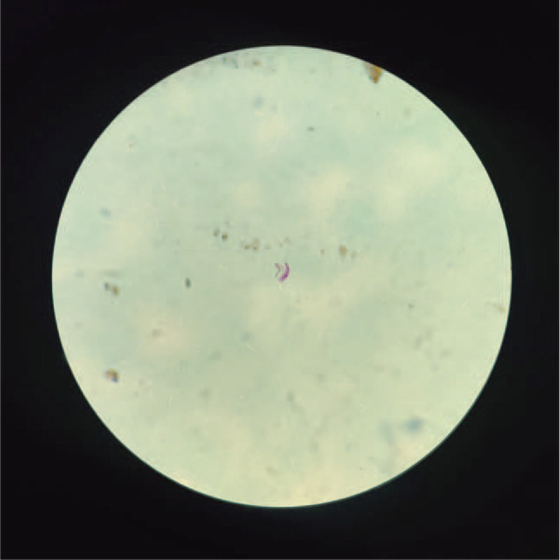 A case report on disseminated tuberculosis in the setting of coronavirus disease 2019: cause or consequence?