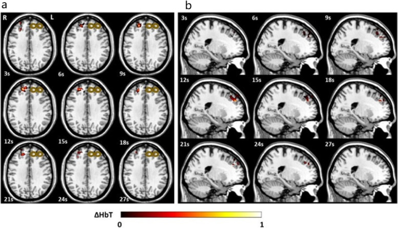 Optical neuroimaging: advancing transcranial magnetic stimulation treatments of psychiatric disorders.