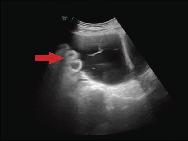 A case report on disseminated tuberculosis in the setting of coronavirus disease 2019: cause or consequence?