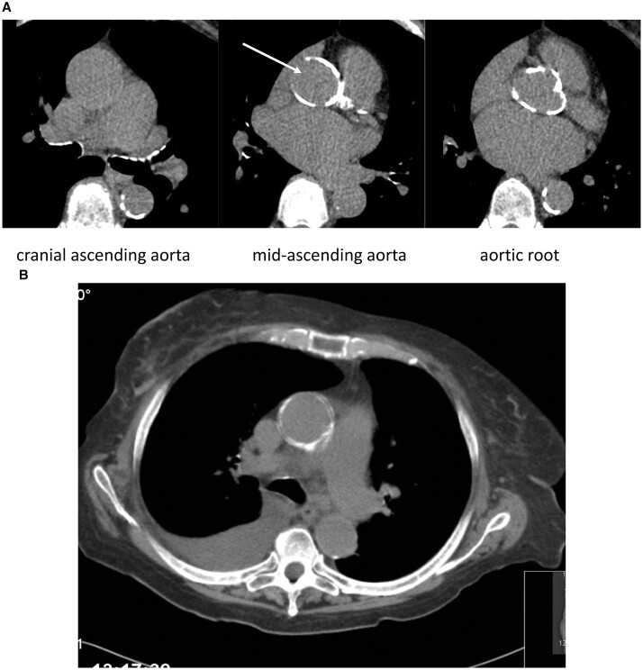 Porcelain aorta does not mean inoperability but needs special strategies.