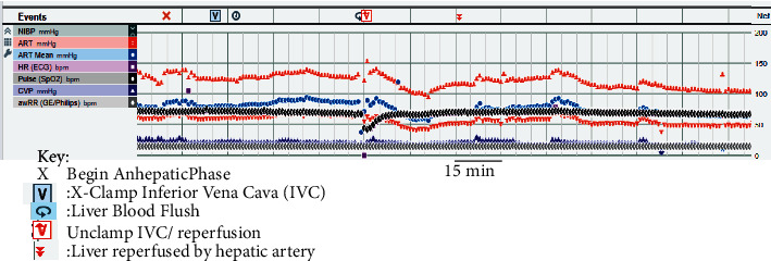 Orthotopic Liver Transplantation in a Patient with Acutely Decompensated Liver Disease and Personal History of Malignant Hyperthermia.