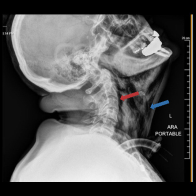 Subcutaneous Emphysema Following Open Tracheostomy During Tracheostomy Mask Ventilation.