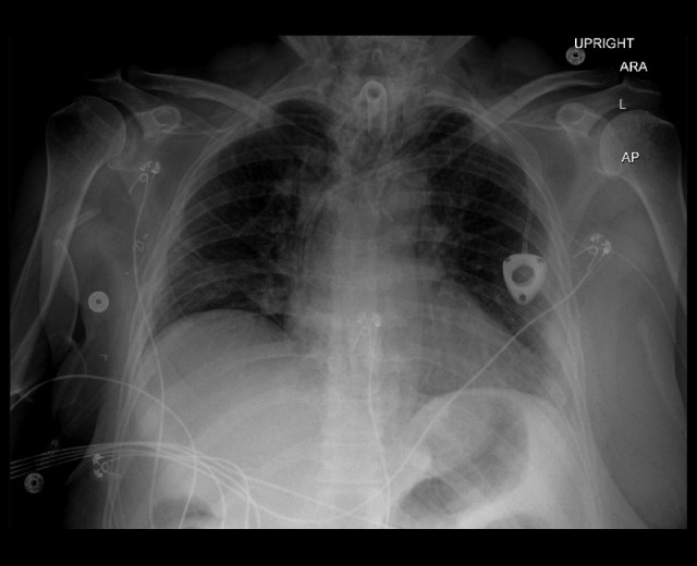 Subcutaneous Emphysema Following Open Tracheostomy During Tracheostomy Mask Ventilation.