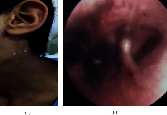 Disseminated Pulmonary Mycosis Caused by <i>Candida tropicalis</i> in an 11-Year-Old Male Patient with Chronic Granulomatous Disease.