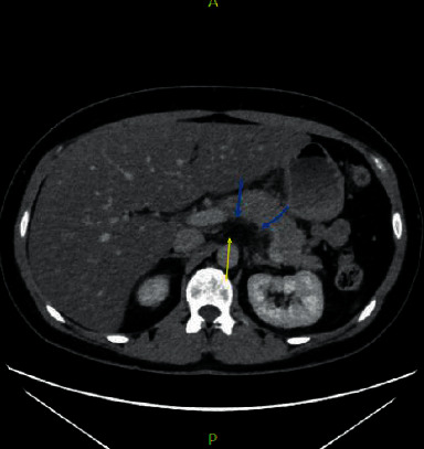 Safety and Efficacy of Insulin and Heparin in the Management of Hypertriglyceridemia-Induced Pancreatitis in a Patient without Diabetes: A Case Report.