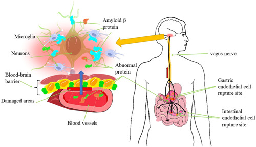 Advances in the study of the relationship between Alzheimer's disease and the gastrointestinal microbiome