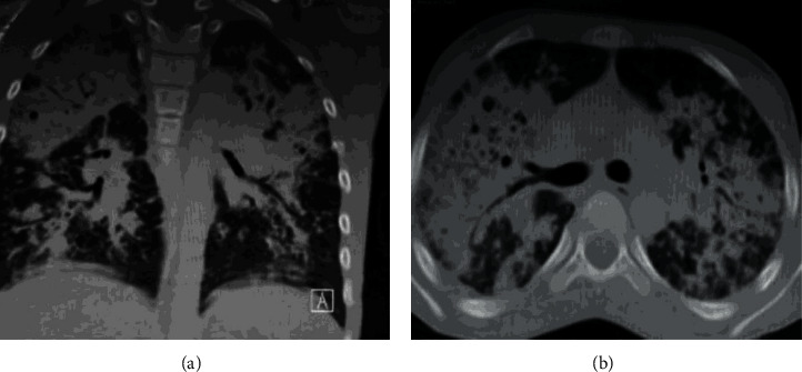 Disseminated Pulmonary Mycosis Caused by <i>Candida tropicalis</i> in an 11-Year-Old Male Patient with Chronic Granulomatous Disease.