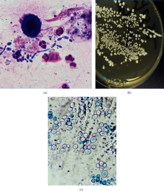 Disseminated Pulmonary Mycosis Caused by <i>Candida tropicalis</i> in an 11-Year-Old Male Patient with Chronic Granulomatous Disease.