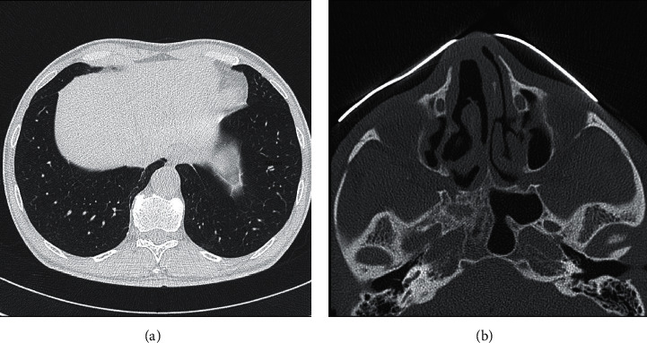 Granulomatosis with Polyangiitis Overlapping with IgG4-Related Disease.