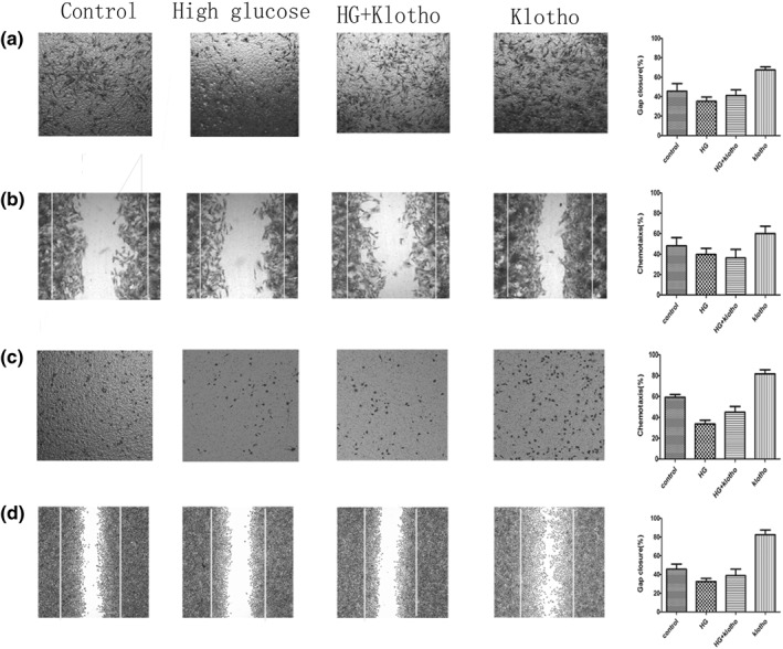 The effect of Klotho protein complexed with nanomaterials on bone mesenchymal stem cell performance in the treatment of diabetic ischaemic ulcer