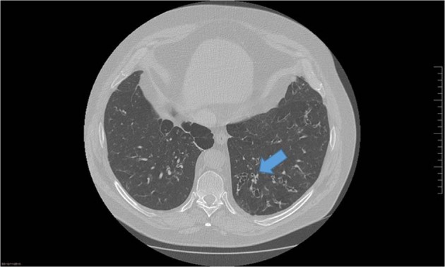 Practical tips in bronchiectasis for Primary Care.