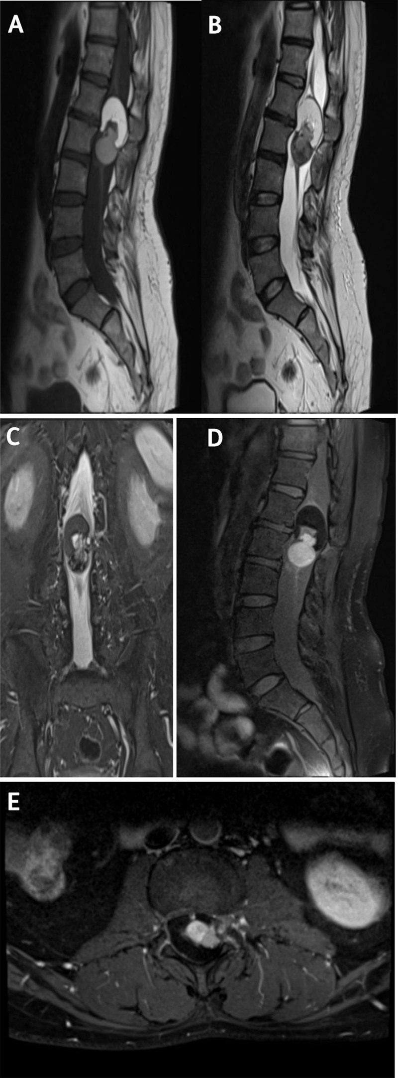 Intramedullary Teratoma of Spine in an Adult Patient.