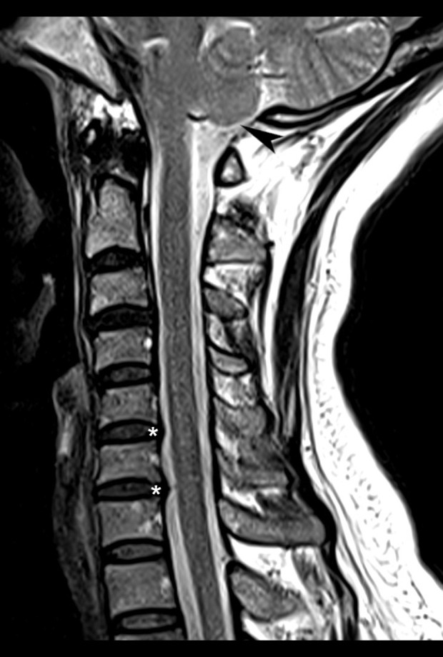 Concurrent Bell's Palsy and Facial Pain Improving with Multimodal Chiropractic Therapy: A Case Report and Literature Review.
