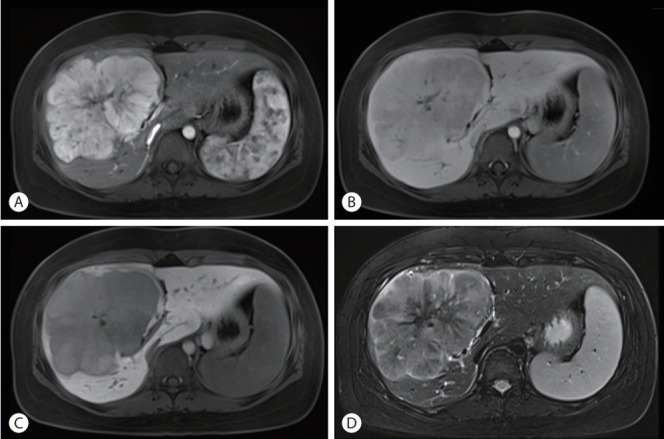 Fibrolamellar hepatocellular carcinoma that was successfully treated with surgical resection: a case report.