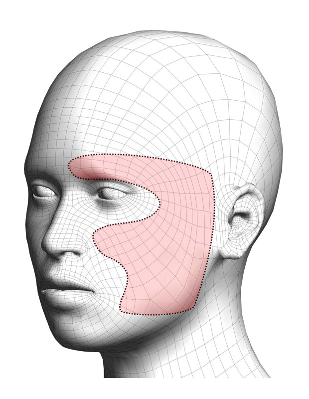 Concurrent Bell's Palsy and Facial Pain Improving with Multimodal Chiropractic Therapy: A Case Report and Literature Review.