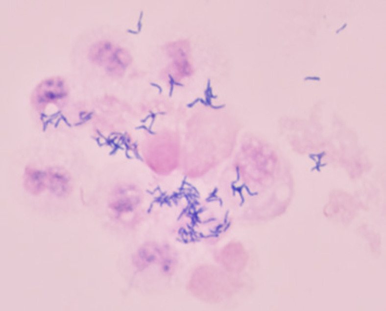 <i>Actinotignum schaalii</i> Can Be an Uropathogen of "Culture-Negative" Febrile Urinary Tract Infections in Children with Urinary Tract Abnormalities.