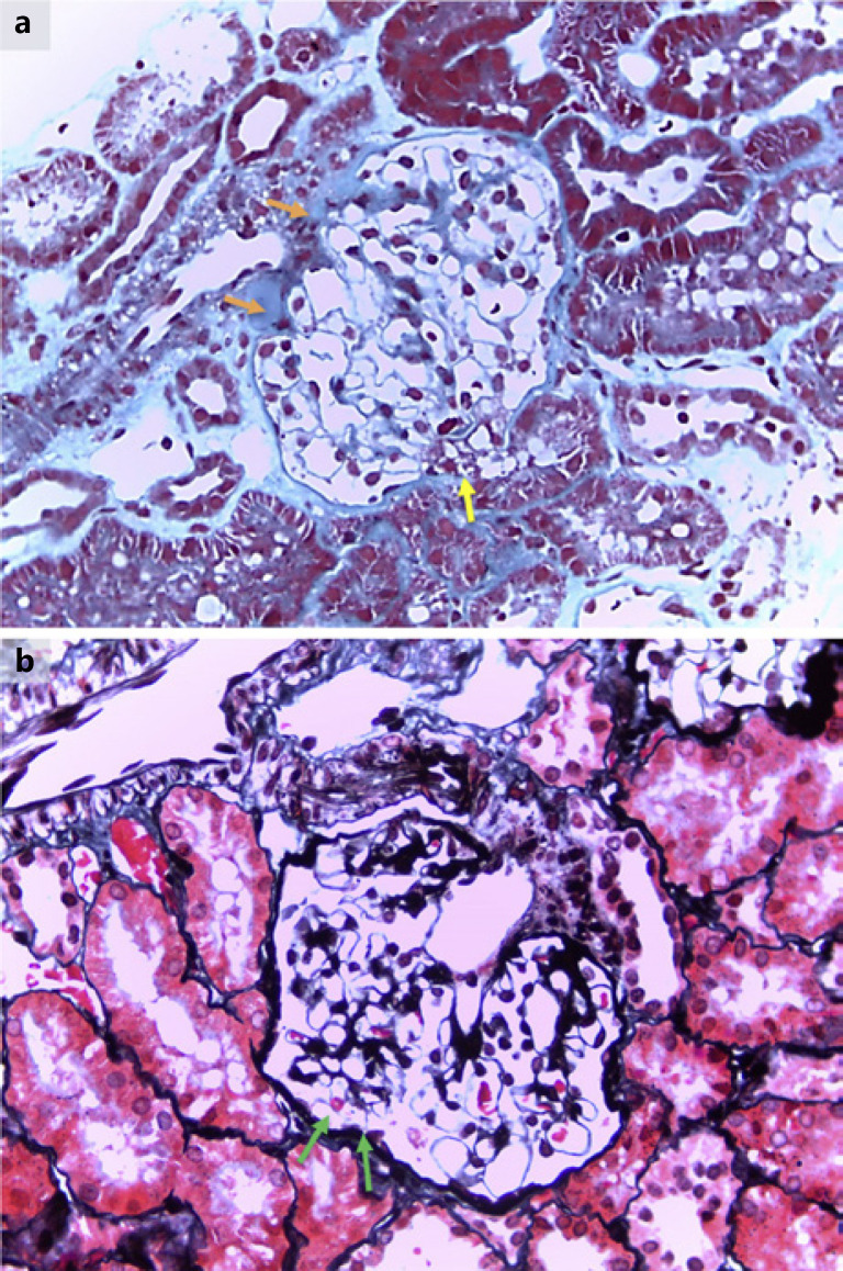 Rituximab, Mycophenolic Acid, and Calcineurin Inhibitors Achieve Long-Term Remission in Pediatric Focal Segmental Glomerulosclerosis with Steroid-Resistant and Frequently Relapsing Nephrotic Syndrome: A Report of Two Cases.