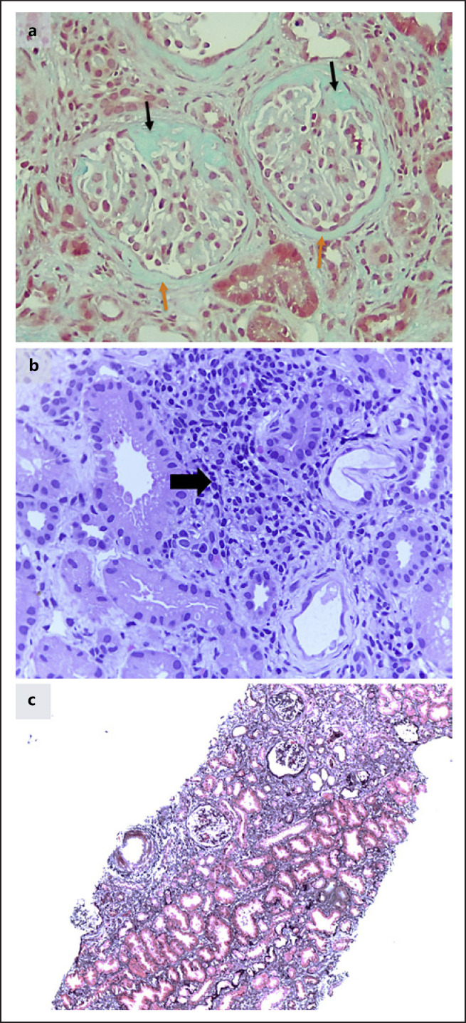 Rituximab, Mycophenolic Acid, and Calcineurin Inhibitors Achieve Long-Term Remission in Pediatric Focal Segmental Glomerulosclerosis with Steroid-Resistant and Frequently Relapsing Nephrotic Syndrome: A Report of Two Cases.