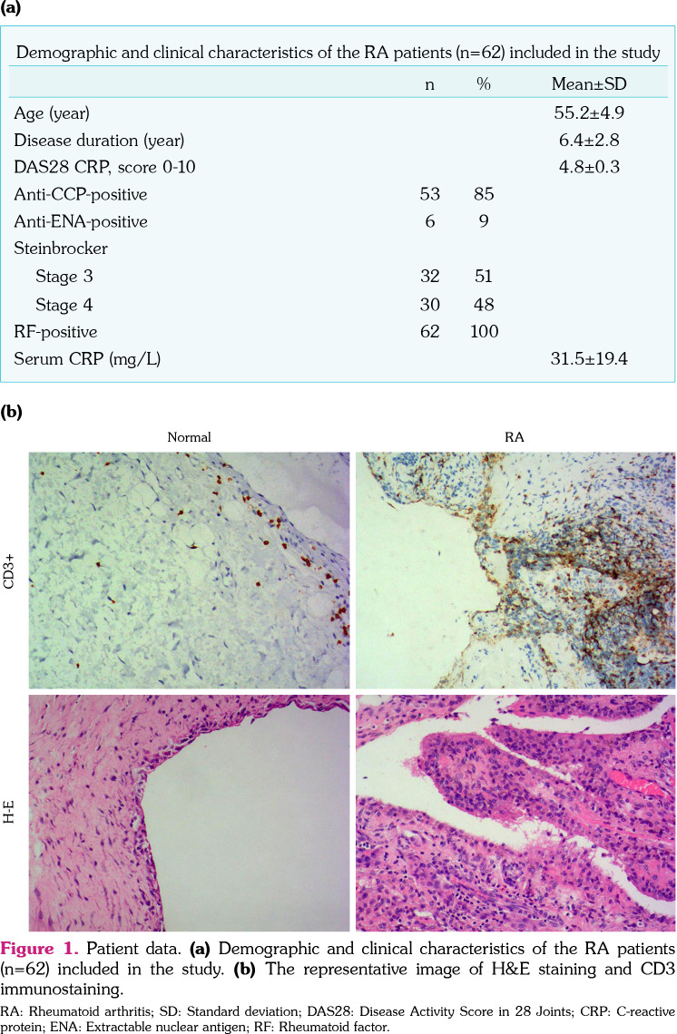 LncRNA cardiac autophagy inhibitory factor is downregulated in rheumatoid arthritis and suppresses the apoptosis of fibroblast-like synoviocytes by promoting the maturation of miRNA-20a.