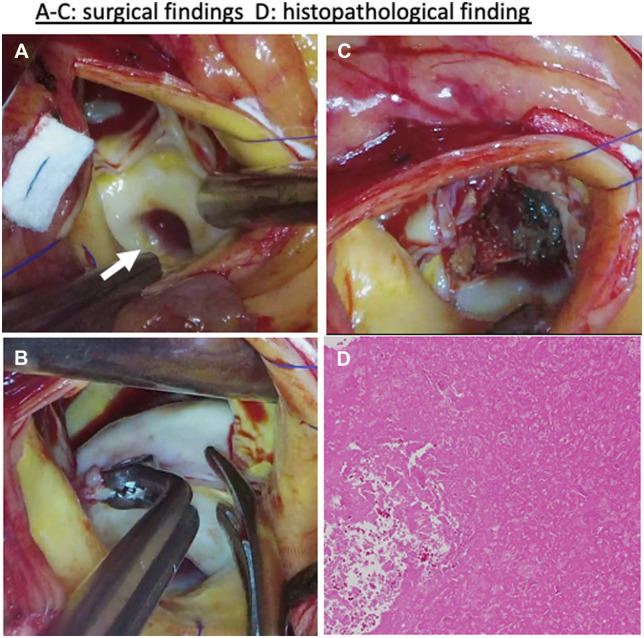 Calcified thrombi of the Valsalva sinuses mimicking an aortic valve tumour.