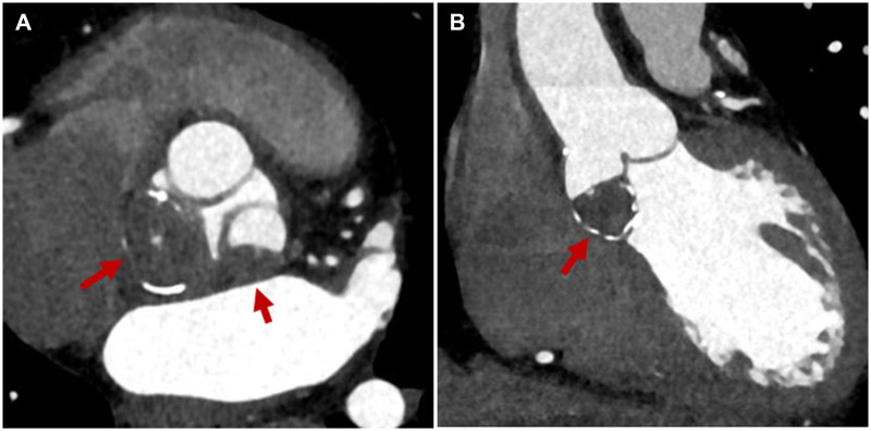 Calcified thrombi of the Valsalva sinuses mimicking an aortic valve tumour.