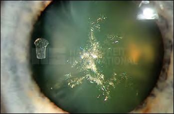 Gender effect on onset, prevalence and surgical treatment of cataract in patients with Myotonic Dystrophy type 1.