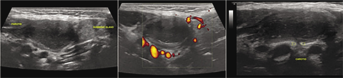 B-mode and Color Doppler Imaging of Different Types of Branchial Cleft Cysts in Children. A Multicenter Study and Review of the Literature.