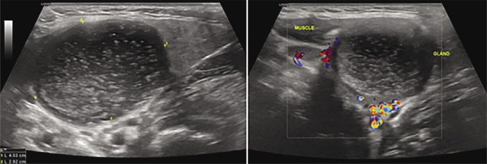 B-mode and Color Doppler Imaging of Different Types of Branchial Cleft Cysts in Children. A Multicenter Study and Review of the Literature.