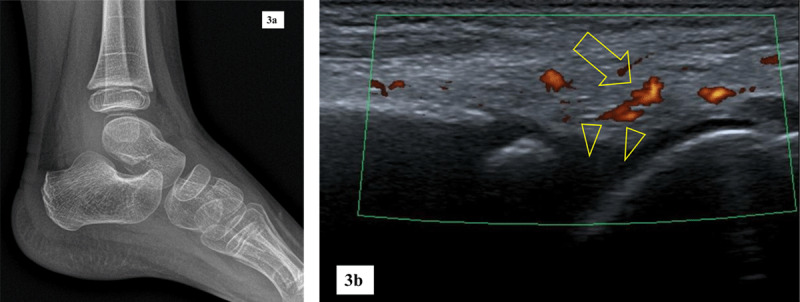 Foot and Ankle Conventional Radiography in Juvenile Idiopathic Arthritis: Does It Still Matter?