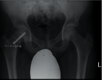 The Effect of the Type of Screw Fixation Used in the Treatment of Slipped Capital Femoral Epiphysis.