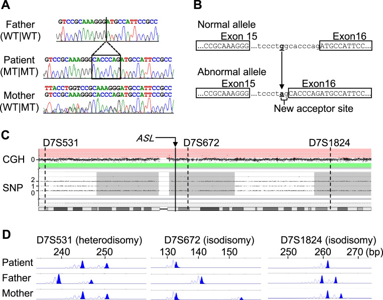 Maternal uniparental disomy of chromosome 7 underlying argininosuccinic aciduria and Silver-Russell syndrome.