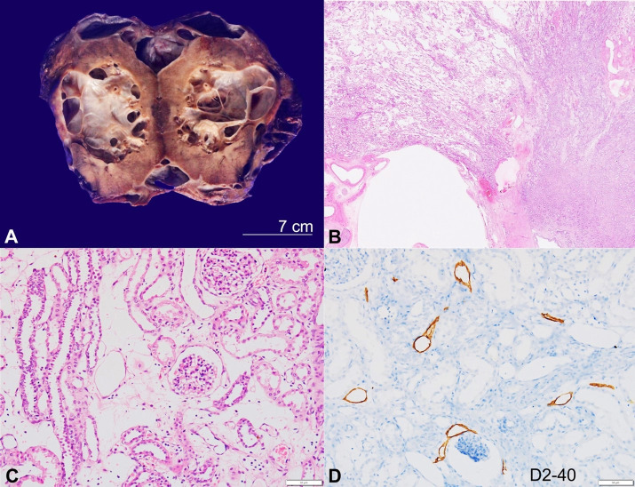 Renal lymphangiectasia.