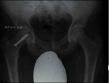 The Effect of the Type of Screw Fixation Used in the Treatment of Slipped Capital Femoral Epiphysis.