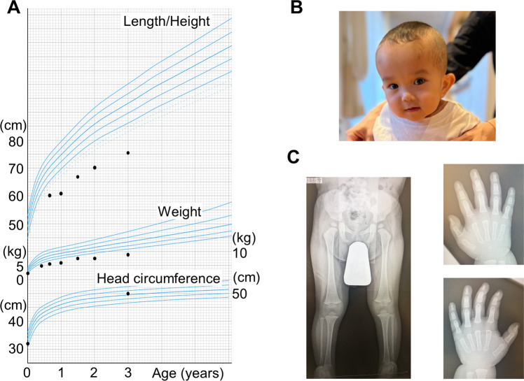 Maternal uniparental disomy of chromosome 7 underlying argininosuccinic aciduria and Silver-Russell syndrome.