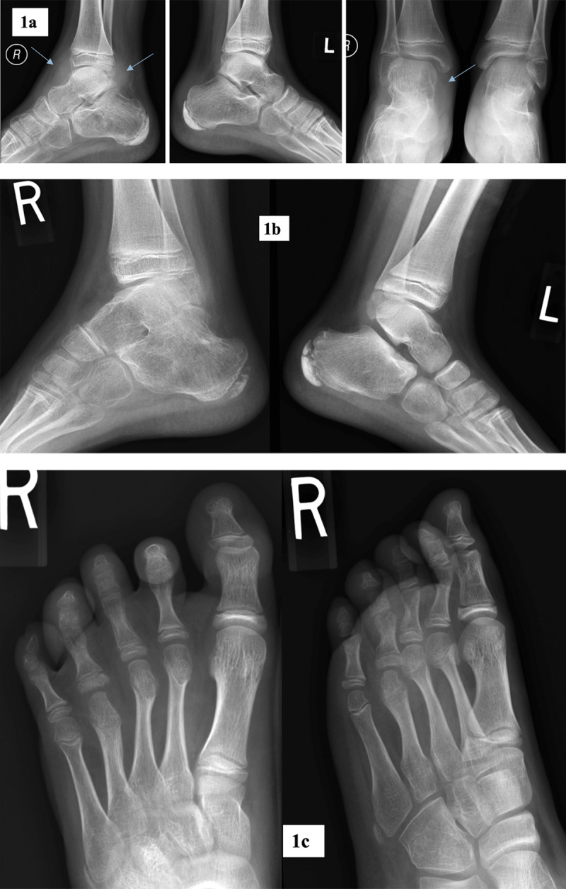 Foot and Ankle Conventional Radiography in Juvenile Idiopathic Arthritis: Does It Still Matter?