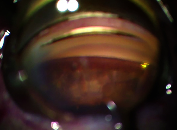 Large Hyphema following Femtosecond Laser-assisted Cataract Surgery (FLACS) and Trabectome Resulting in Endocapsular Hematoma.