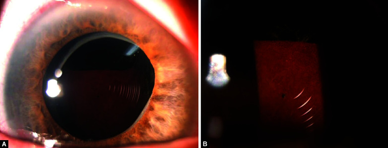 Large Hyphema following Femtosecond Laser-assisted Cataract Surgery (FLACS) and Trabectome Resulting in Endocapsular Hematoma.