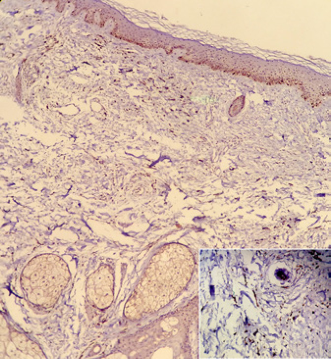 A Report of Unusual Case of Acquired Dermal Melanocytosis on the Scalp of a Caucasian Man with a Literature Review.