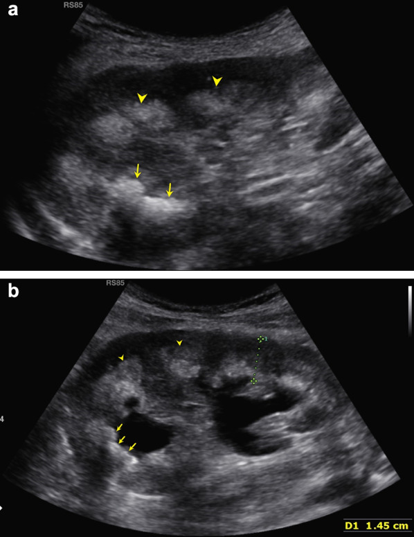 Medullary sponge kidney: unusual finding in kidney transplant recipient.