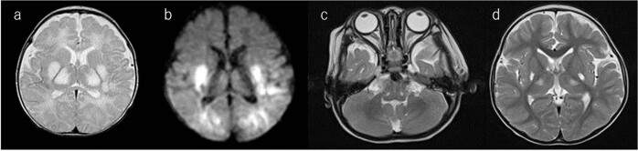 A Japanese patient with neonatal biotin-responsive basal ganglia disease.