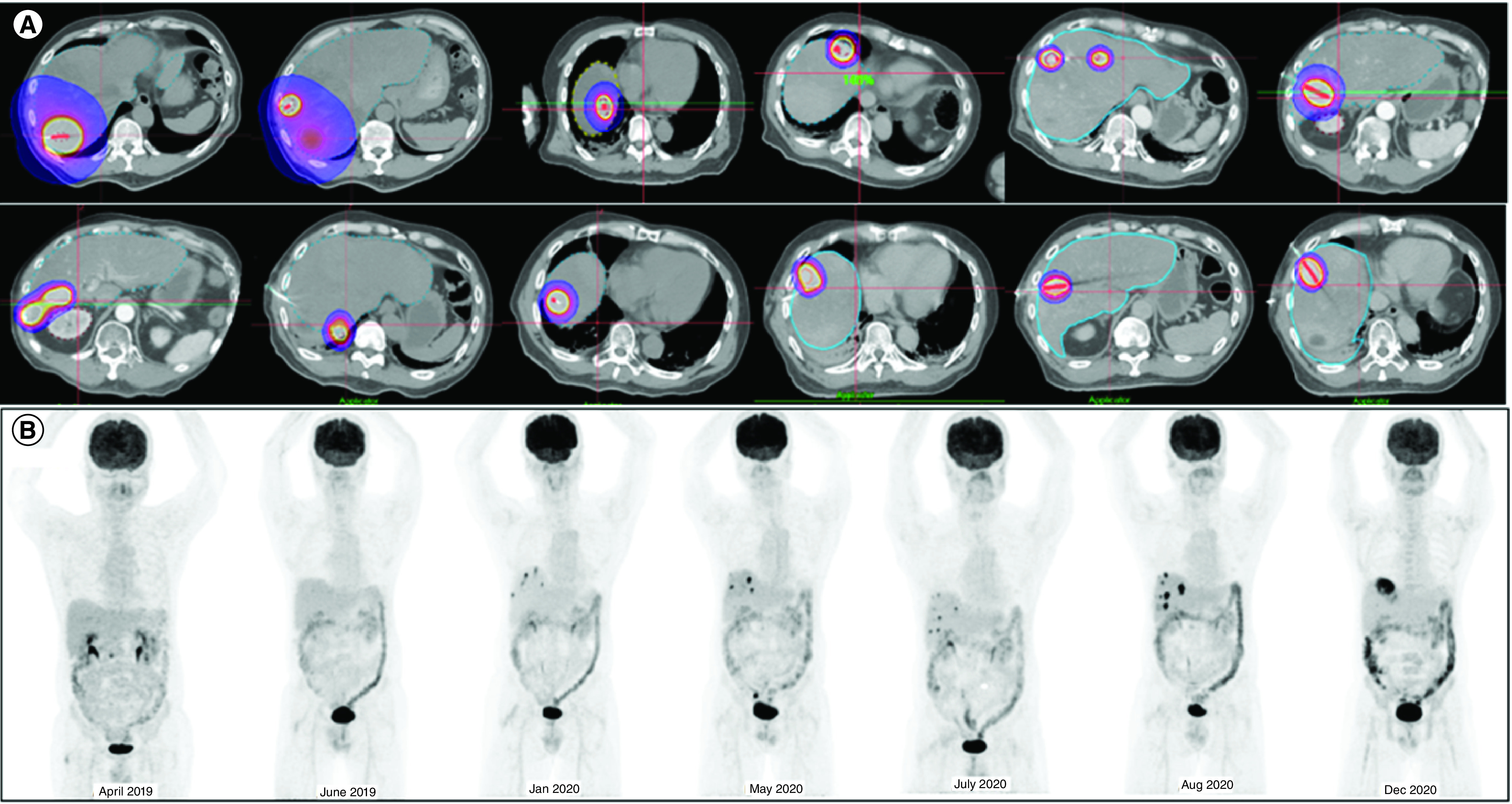 Pathological complete response with immunotherapy and brachytherapy to 15 metastatic liver lesions in a single patient.