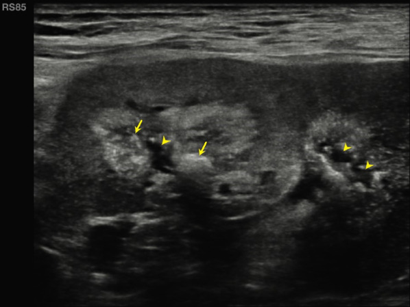 Medullary sponge kidney: unusual finding in kidney transplant recipient.