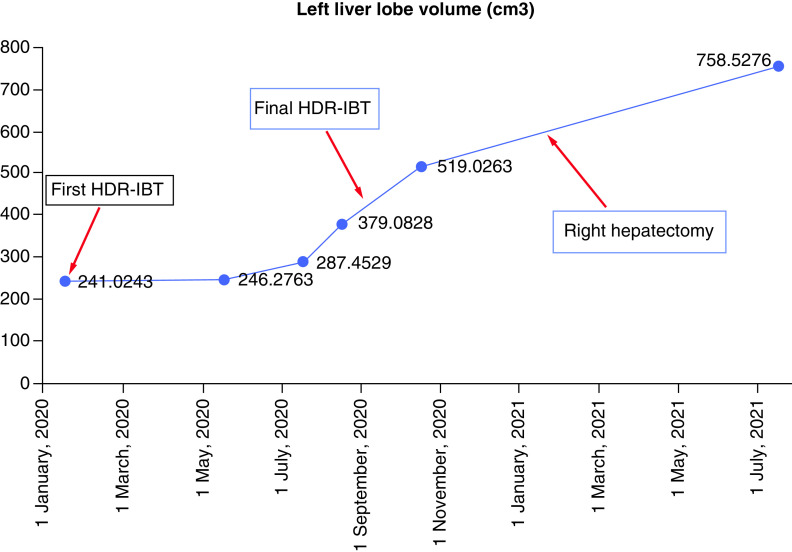 Pathological complete response with immunotherapy and brachytherapy to 15 metastatic liver lesions in a single patient.