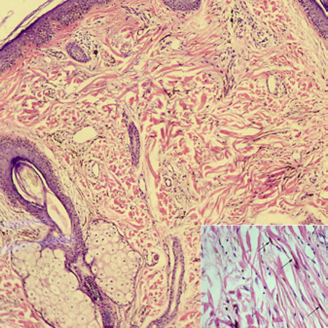 A Report of Unusual Case of Acquired Dermal Melanocytosis on the Scalp of a Caucasian Man with a Literature Review.